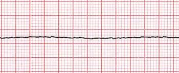 Asystole